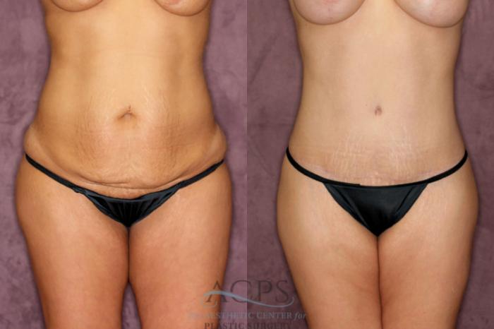 Before & After Liposuction Case 164 Front View: View in Houston, TX