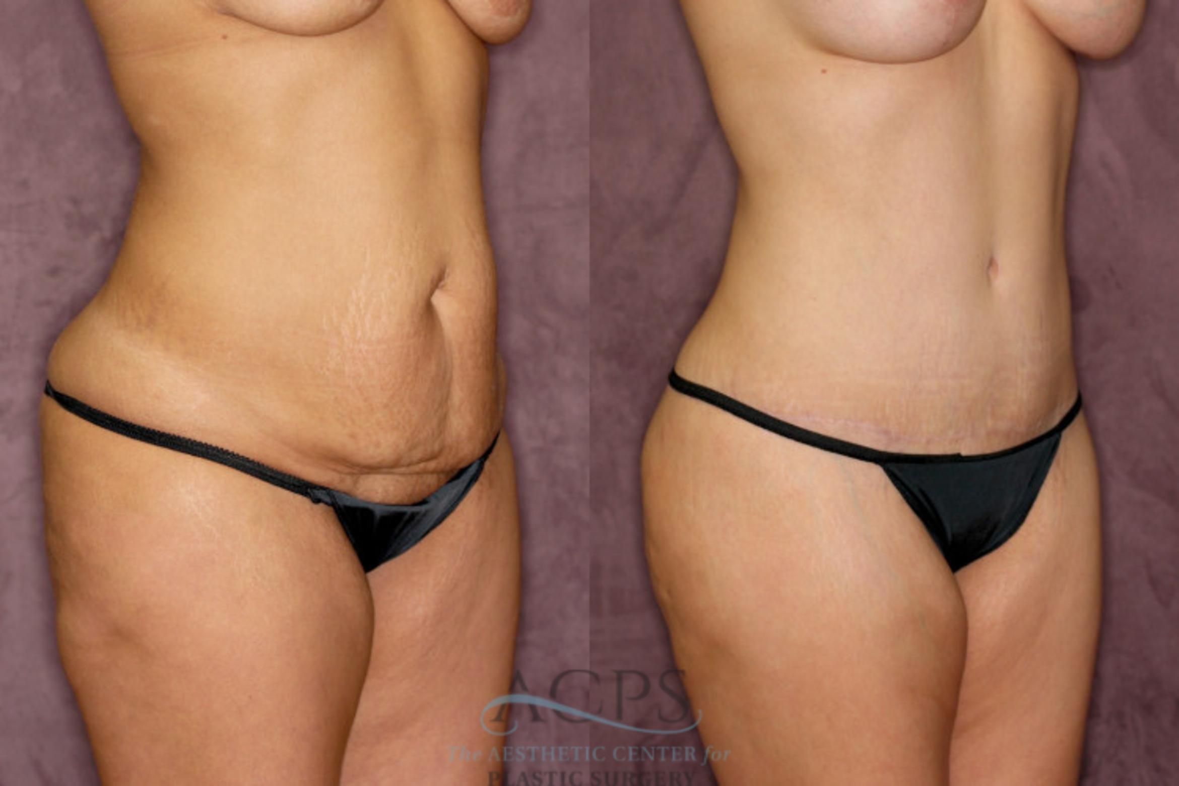 Before & After Body Lift Case 164 Oblique Right View: View in Houston, TX