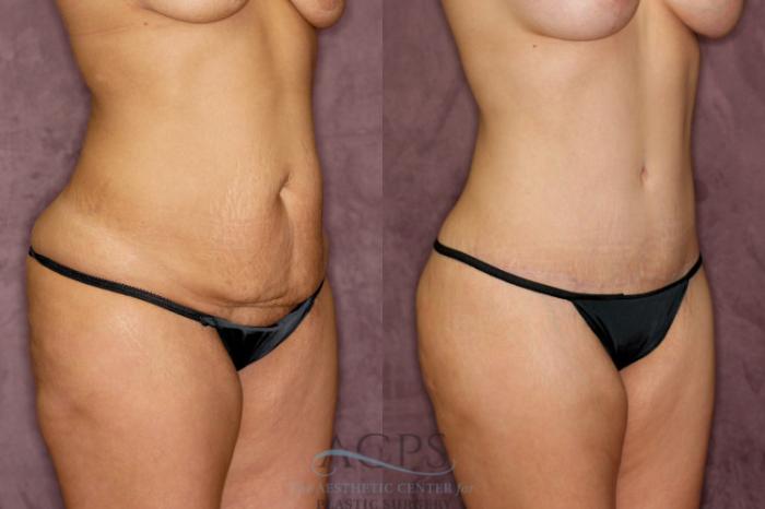 Before & After Body Lift Case 164 Oblique Right View: View in Houston, TX