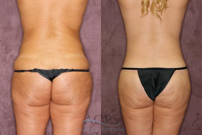 Before & After Body Lift Case 164 Rear View: View in Houston, TX