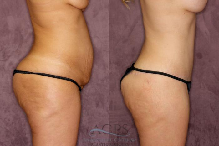 Before & After Body Lift Case 164 Side Right View: View in Houston, TX