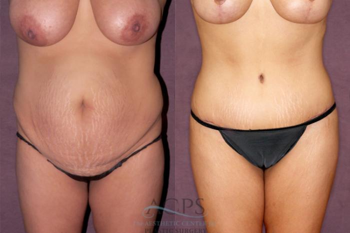 Before & After Tummy Tuck Case 165 Front View: View in Houston, TX