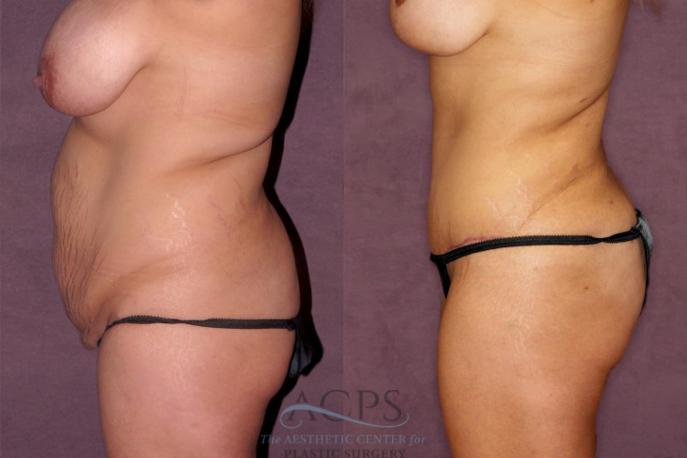 Before & After Tummy Tuck Case 165 Oblique Left View: View in Houston, TX