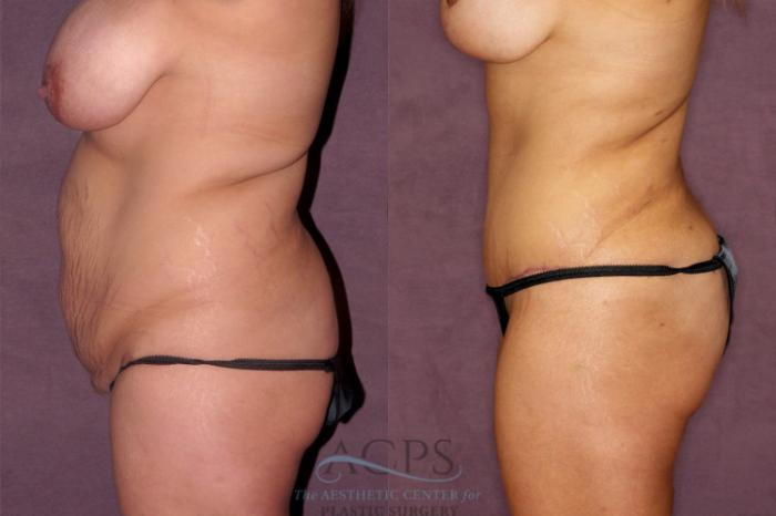 Before & After Tummy Tuck Case 165 Oblique Left View: View in Houston, TX