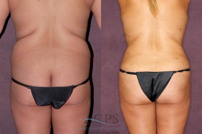 Before & After Tummy Tuck Case 165 Rear View: View in Houston, TX