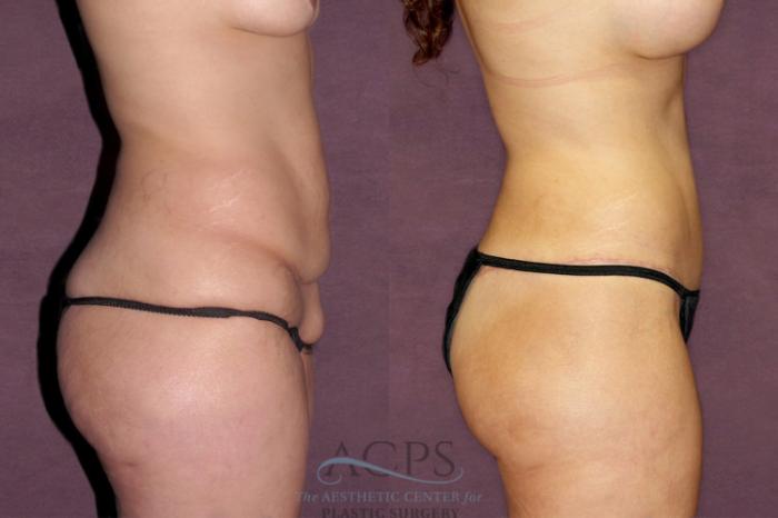 Before & After Body Lift Case 166 Oblique Right View: View in Houston, TX