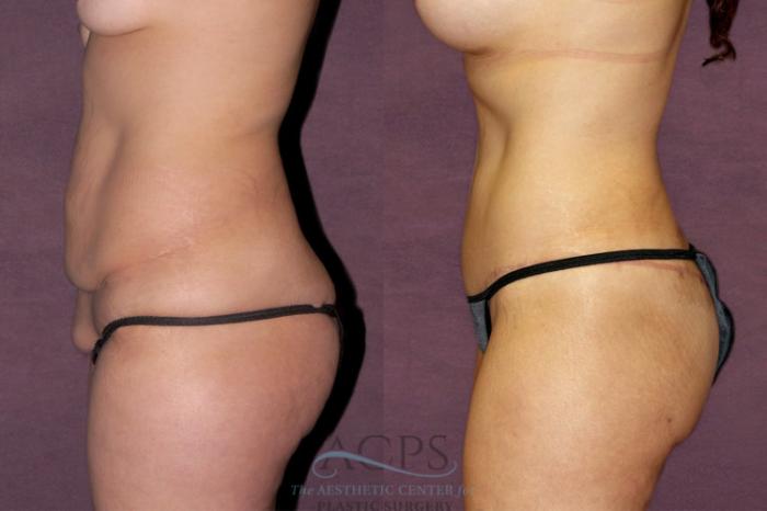 Before & After Body Lift Case 166 Side Left View: View in Houston, TX