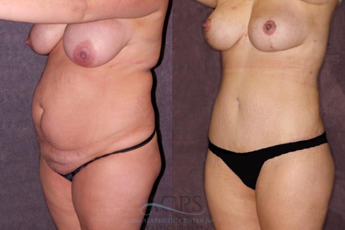 Before & After Liposuction Case 167 Oblique Left View: View in Houston, TX