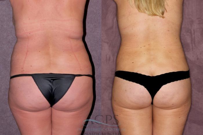 Before & After Liposuction Case 167 Rear View: View in Houston, TX