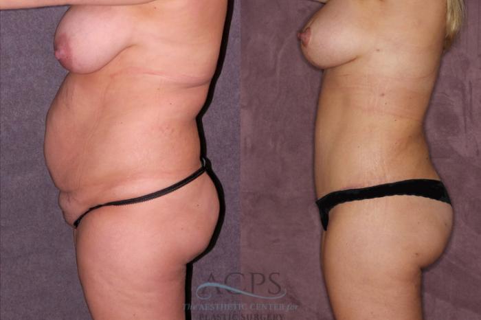 Before & After Liposuction Case 167 Side Left View: View in Houston, TX