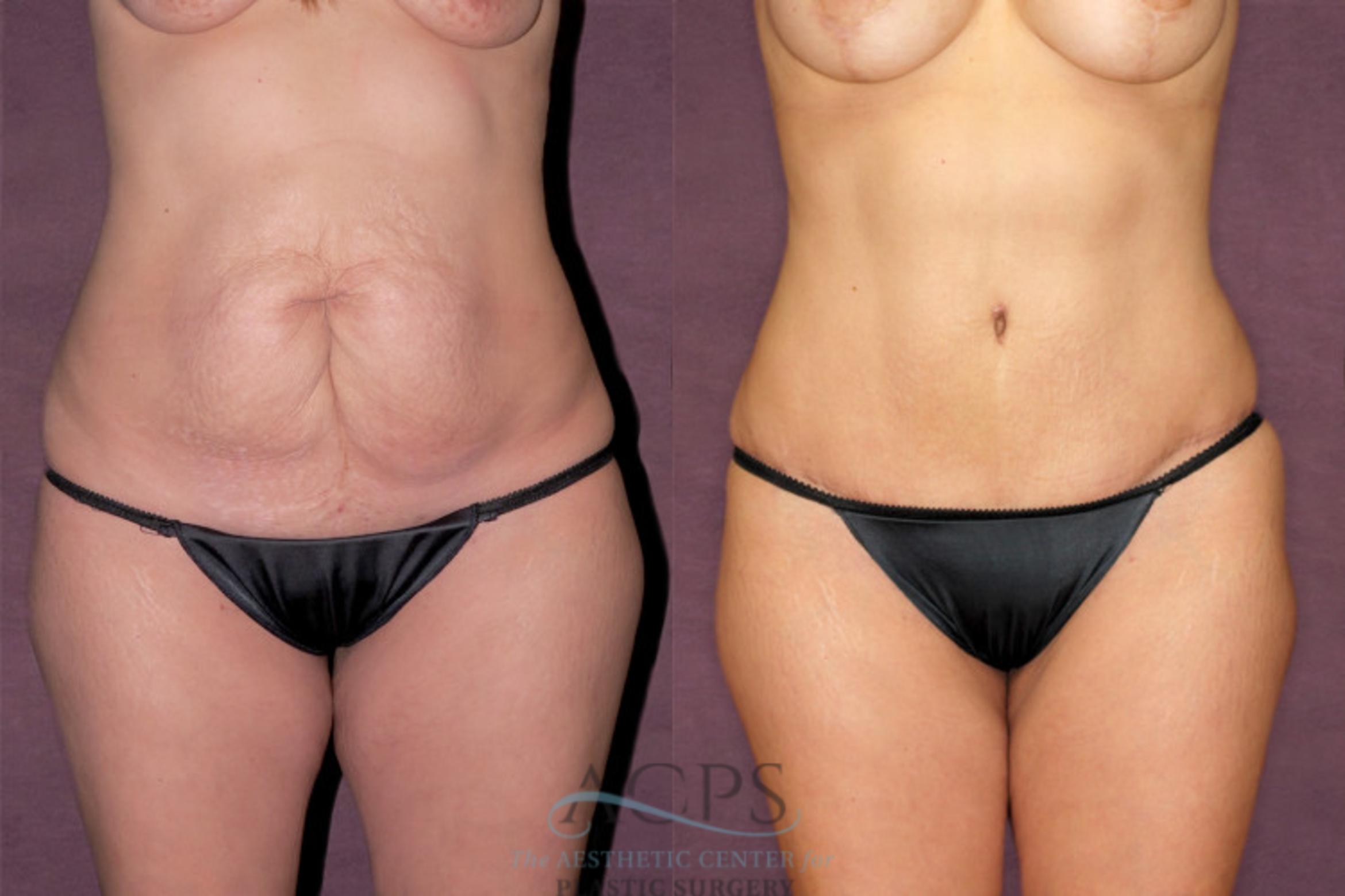 Before & After Mommy Makeover Case 168 Front View: View in Houston, TX