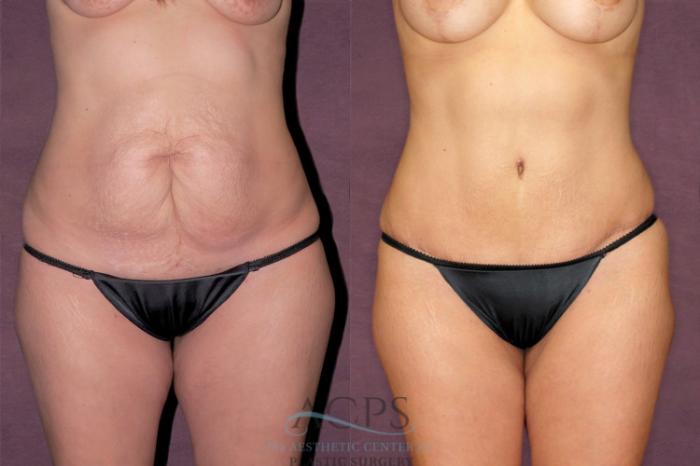 Before & After Mommy Makeover Case 168 Front View: View in Houston, TX