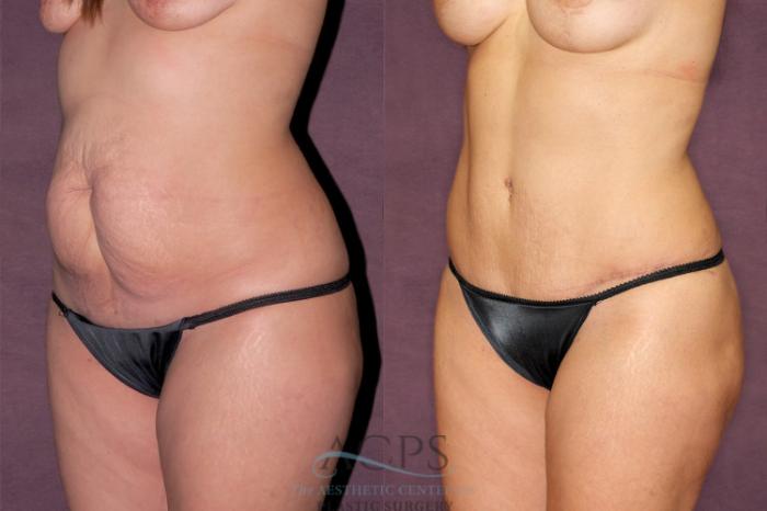 Before & After Mommy Makeover Case 168 Oblique Left View: View in Houston, TX