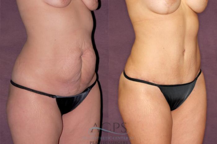 Before & After Mommy Makeover Case 168 Oblique Right View: View in Houston, TX