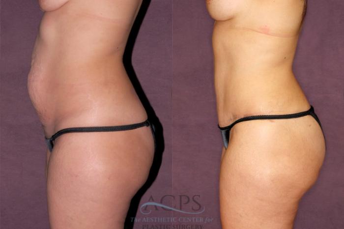 Before & After Mommy Makeover Case 168 Side Left View: View in Houston, TX