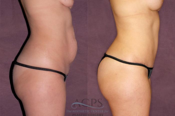 Before & After Mommy Makeover Case 168 Side Right View: View in Houston, TX