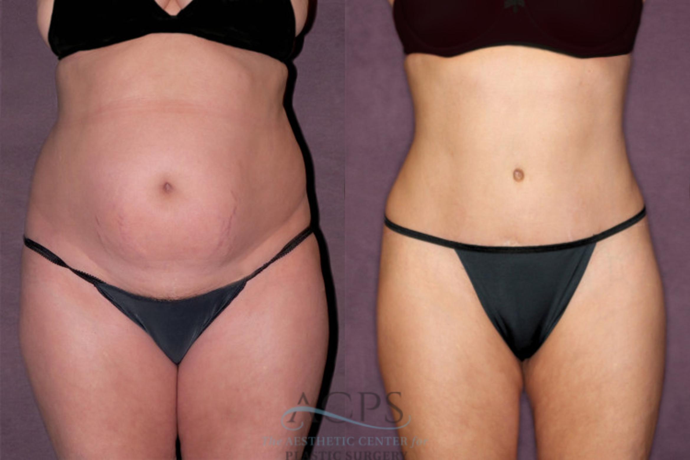 Before & After Tummy Tuck Case 169 Front View: View in Houston, TX
