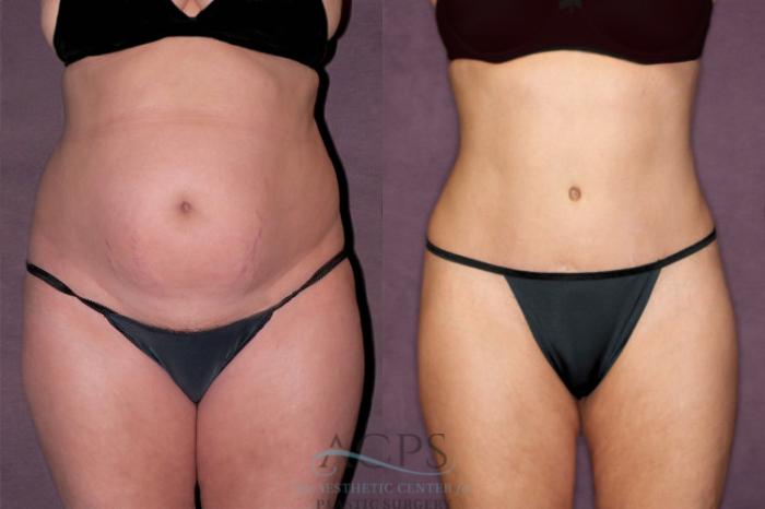 Before & After Tummy Tuck Case 169 Front View: View in Houston, TX