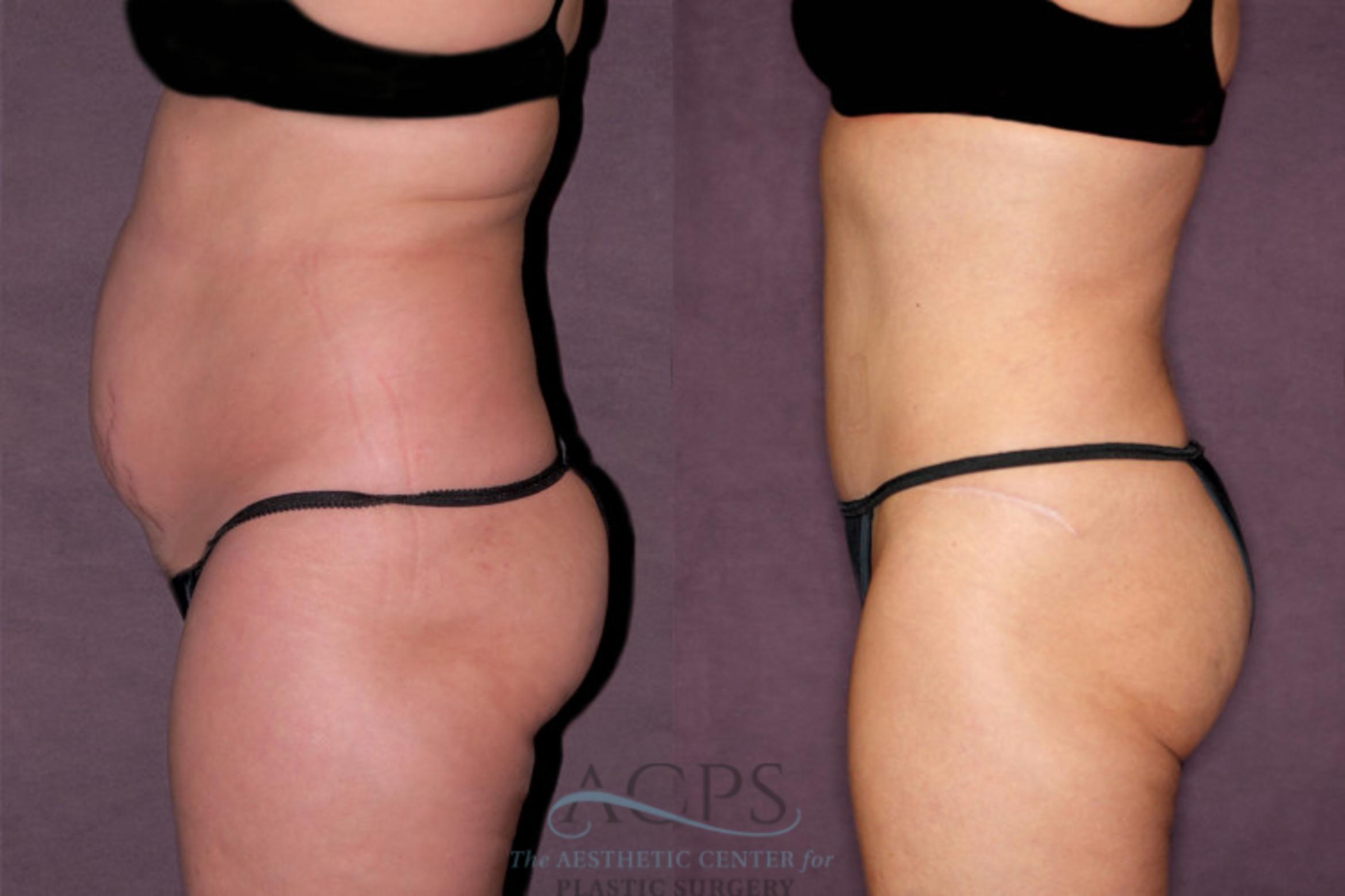 Before & After Tummy Tuck Case 169 Oblique Left View: View in Houston, TX
