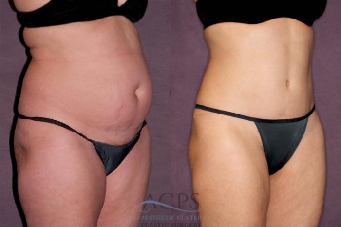Before & After Tummy Tuck Case 169 Oblique Right View: View in Houston, TX