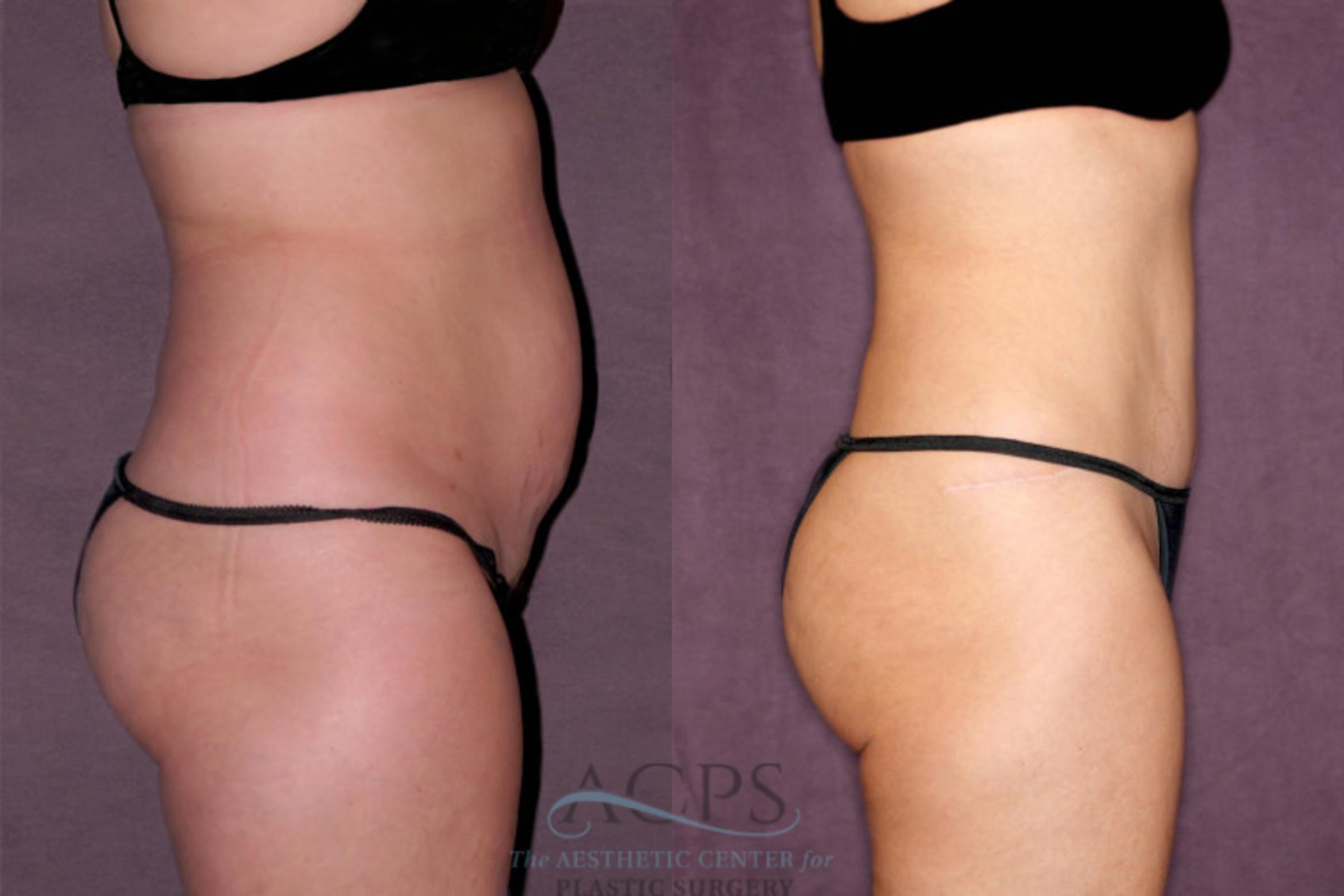 Before & After Tummy Tuck Case 169 Side Right View: View in Houston, TX