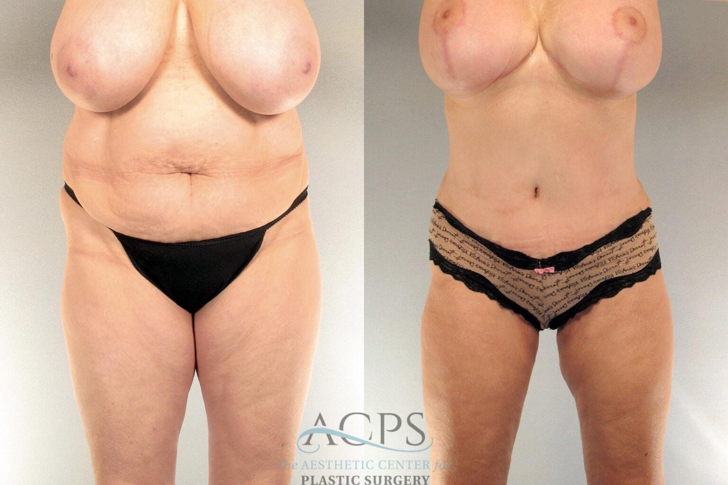 Before & After Tummy Tuck Case 17 Front View: View in Houston, TX