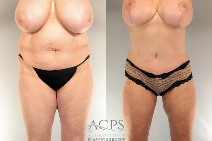 Before & After Tummy Tuck Case 17 Front View: View in Houston, TX