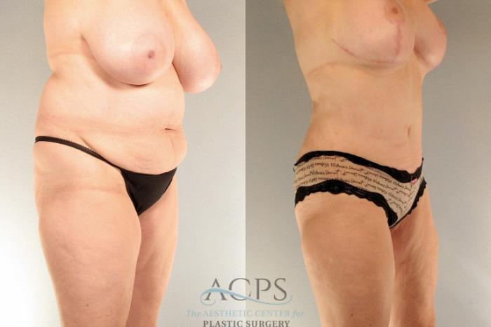 Before & After Tummy Tuck Case 17 Oblique View: View in Houston, TX