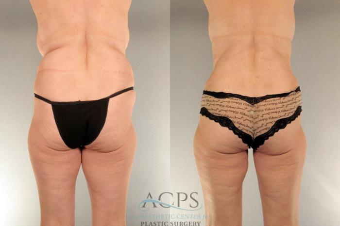 Before & After Tummy Tuck Case 17 Rear View: View in Houston, TX