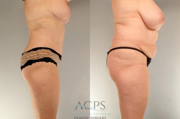 Before & After Tummy Tuck Case 17 Side View: View in Houston, TX