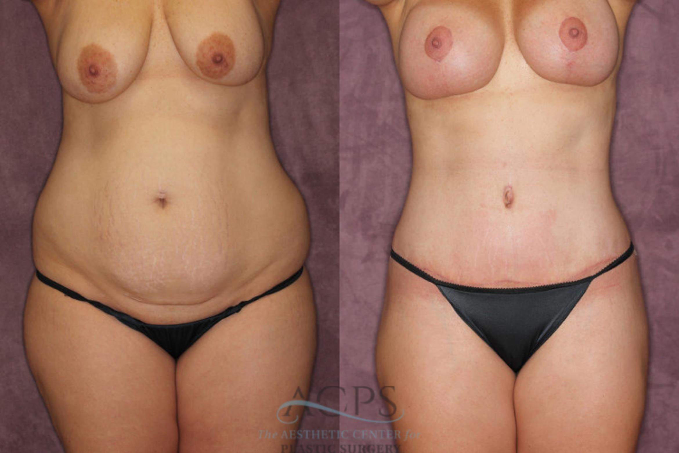 Before & After Mommy Makeover Case 171 Front View: View in Houston, TX