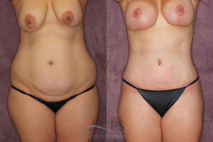 Before & After Mommy Makeover Case 171 Front View: View in Houston, TX