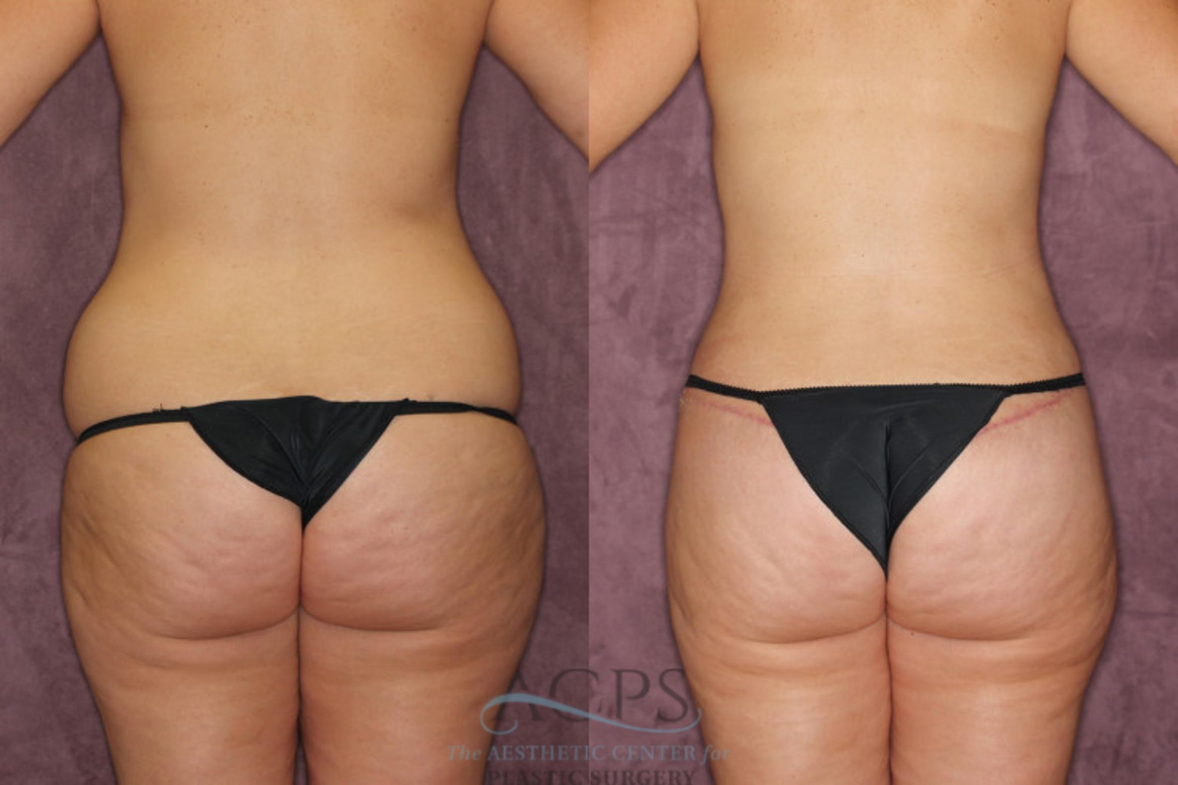 Before & After Mommy Makeover Case 171 Rear View: View in Houston, TX