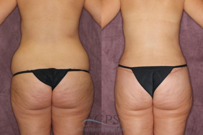 Before & After Mommy Makeover Case 171 Rear View: View in Houston, TX