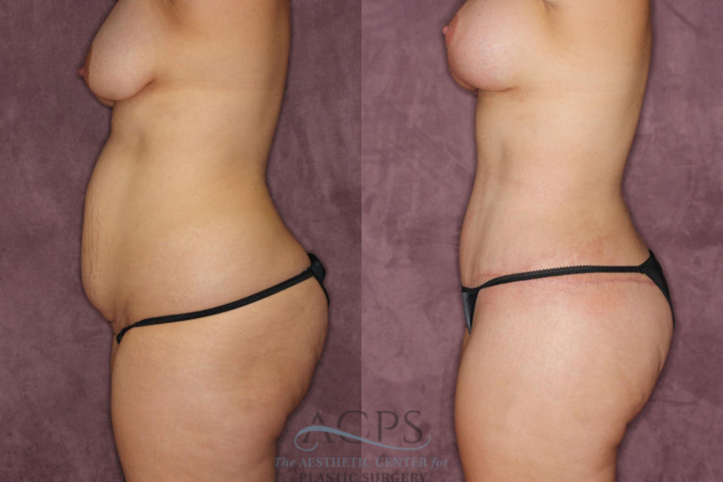 Before & After Mommy Makeover Case 171 Side Left View: View in Houston, TX