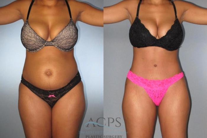 Before & After Tummy Tuck Case 172 Front View: View in Houston, TX
