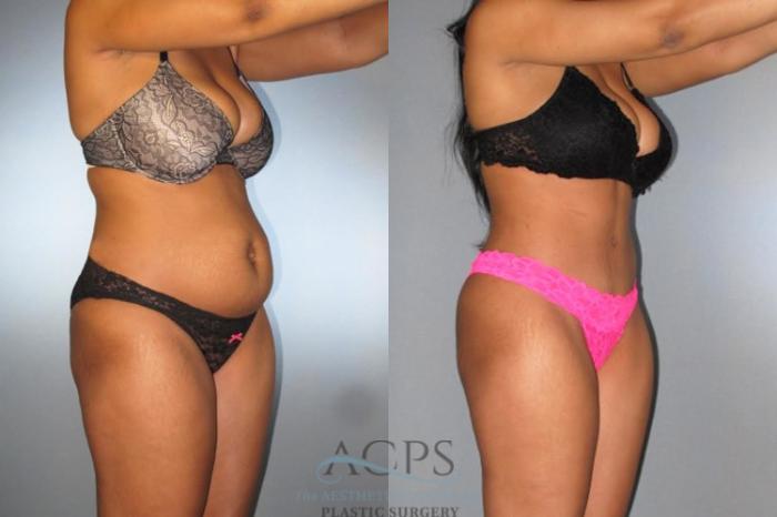 Before & After Tummy Tuck Case 172 Oblique View: View in Houston, TX