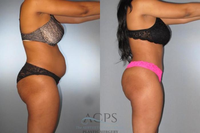 Before & After Tummy Tuck Case 172 Side View: View in Houston, TX
