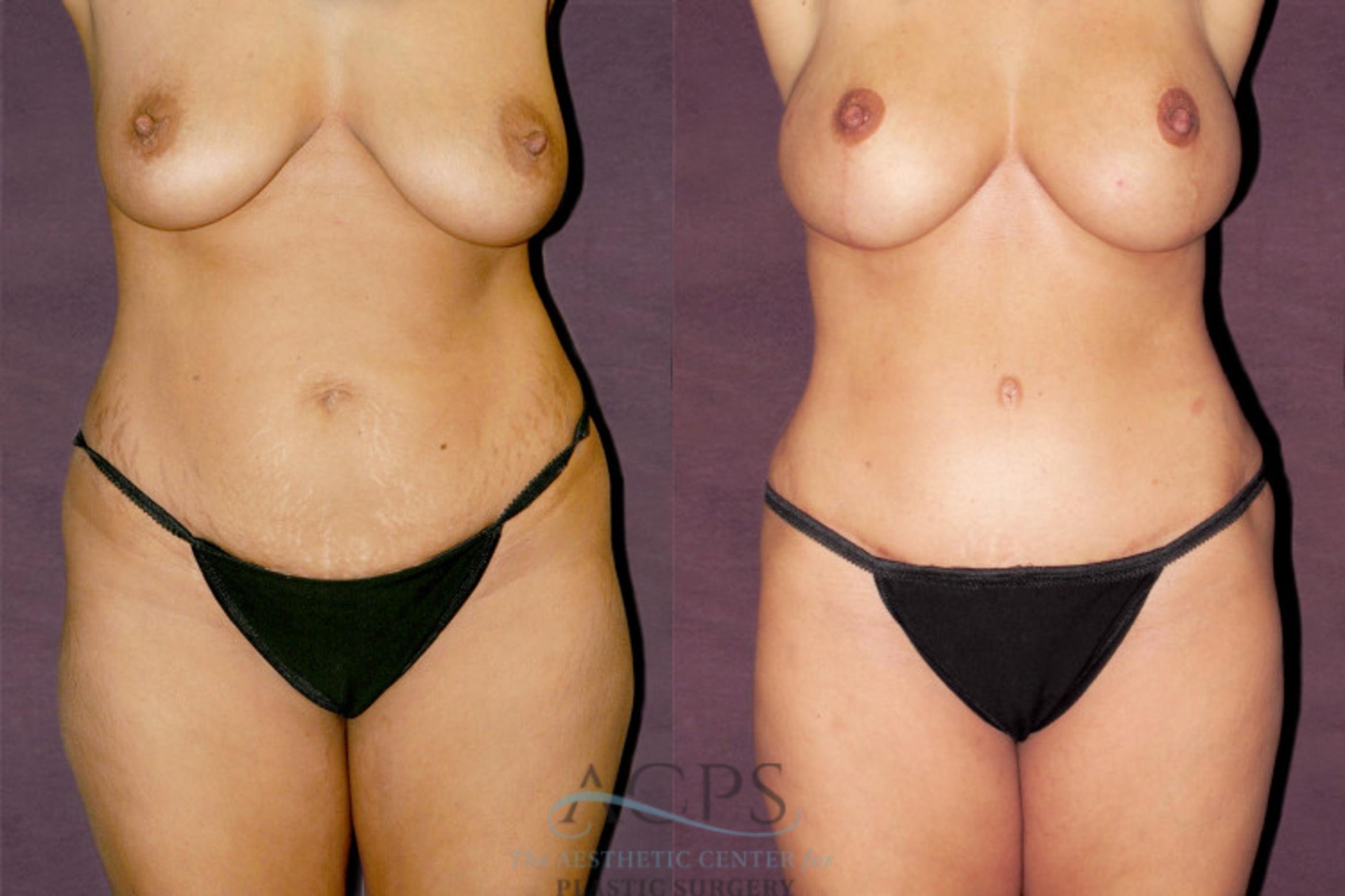 Before & After Tummy Tuck Case 173 Front View: View in Houston, TX