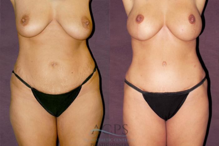 Before & After Liposuction Case 173 Front View: View in Houston, TX