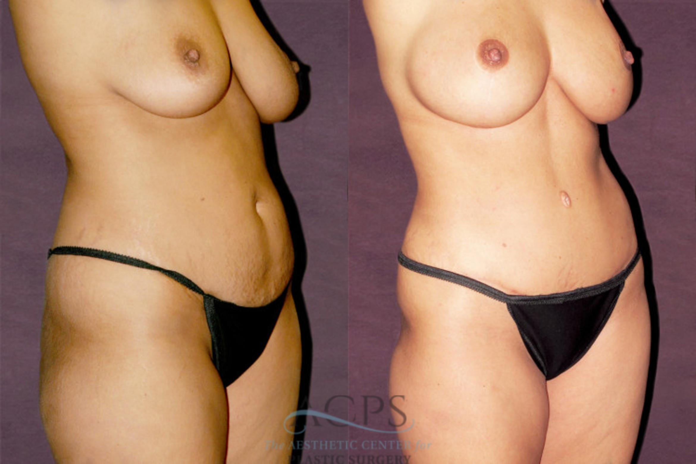 Before & After Tummy Tuck Case 173 Oblique Right View: View in Houston, TX