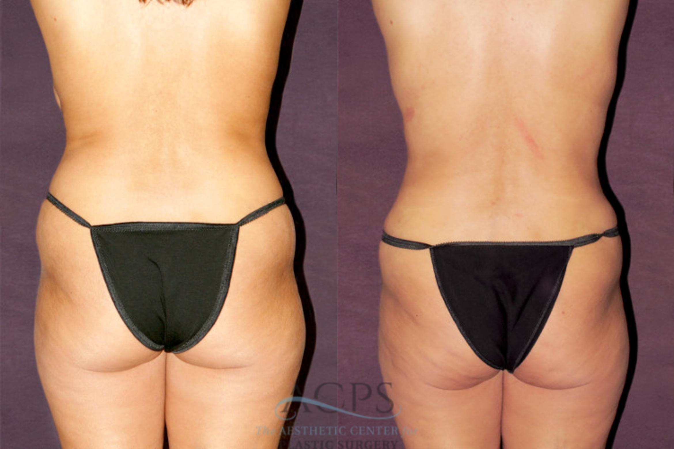 Before & After Tummy Tuck Case 173 Rear View: View in Houston, TX
