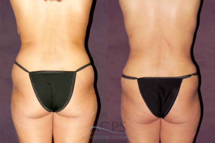 Before & After Tummy Tuck Case 173 Rear View: View in Houston, TX