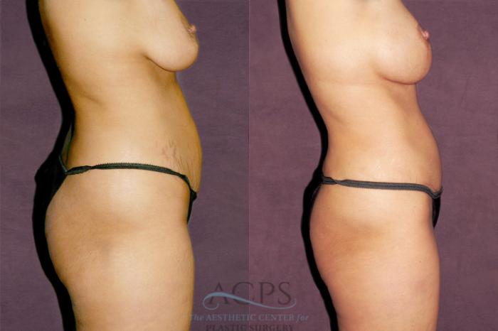 Before & After Tummy Tuck Case 173 Side Right View: View in Houston, TX