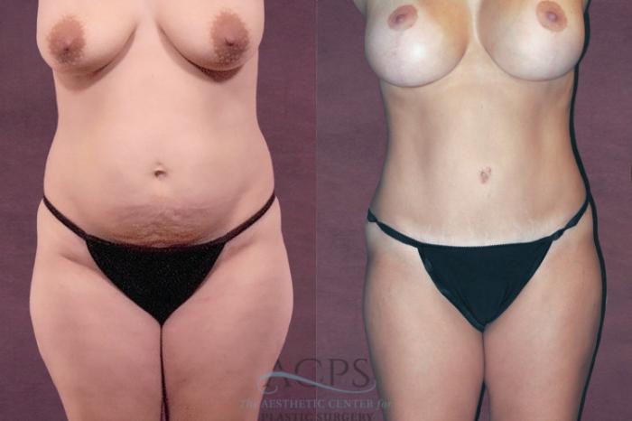 Before & After Mommy Makeover Case 174 Front View: View in Houston, TX