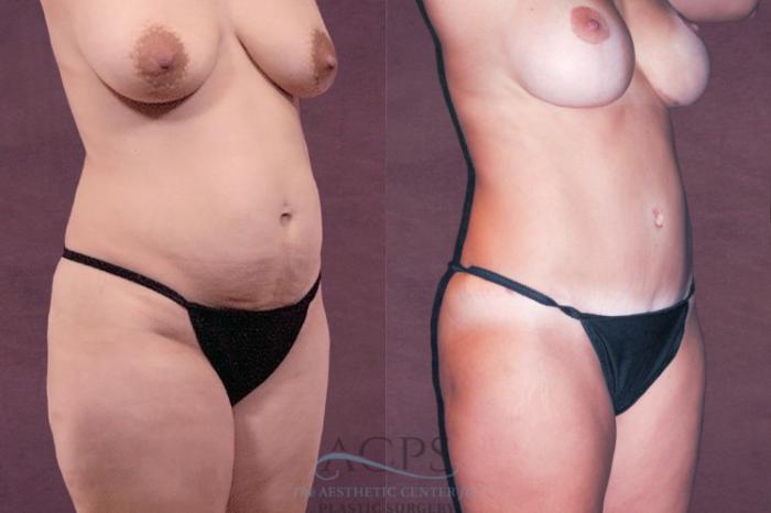 Before & After Mommy Makeover Case 174 Oblique Right View: View in Houston, TX
