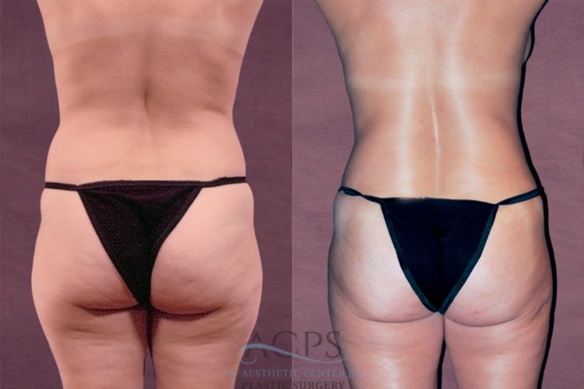 Before & After Mommy Makeover Case 174 Rear View: View in Houston, TX