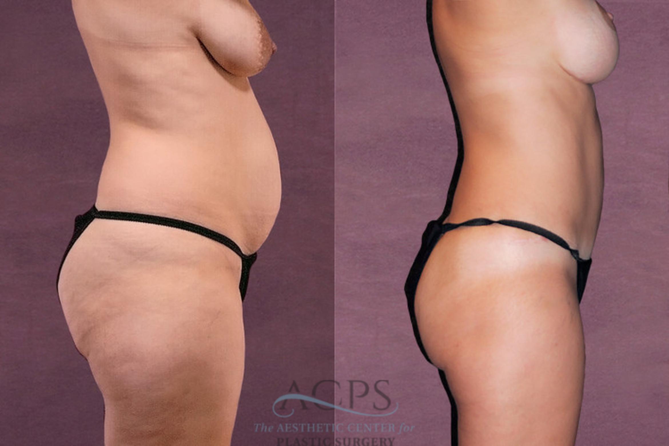 Before & After Mommy Makeover Case 174 Side Right View: View in Houston, TX