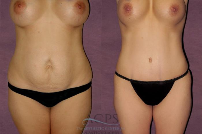 Before & After Mommy Makeover Case 175 Front View: View in Houston, TX