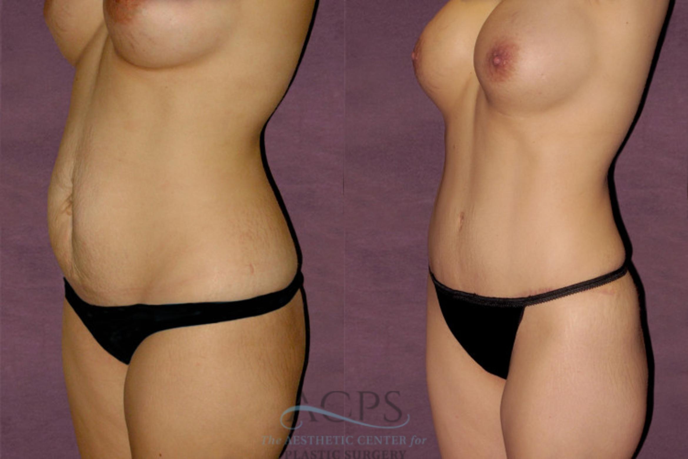 Before & After Mommy Makeover Case 175 Oblique Left View: View in Houston, TX
